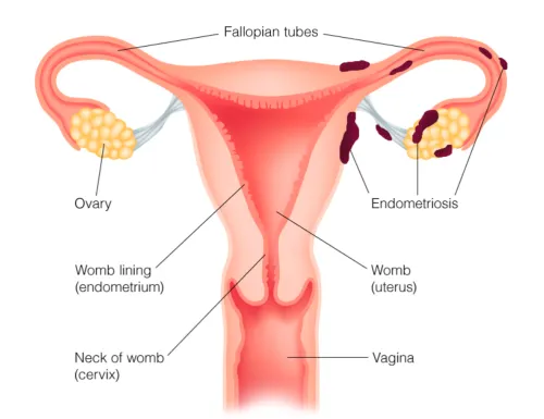 endometriózis