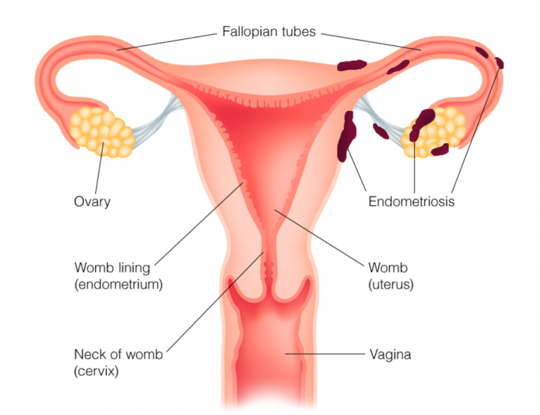 endometriózis