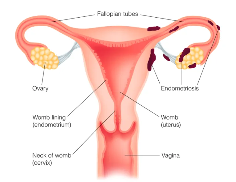 endometriózis