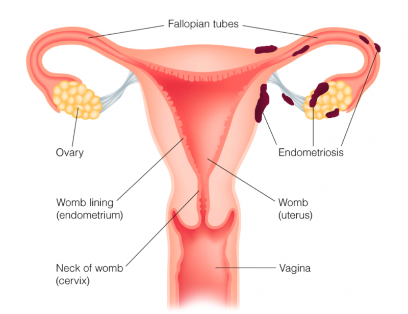 Az endometriózis okai és tünetei