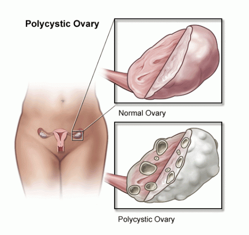 pcos